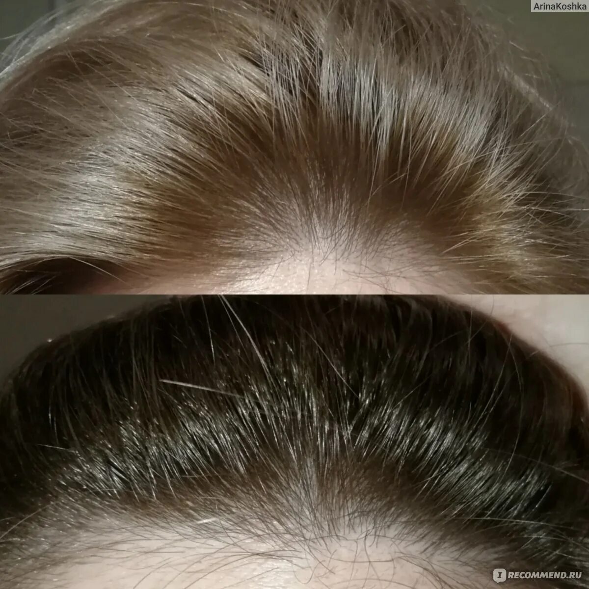 Снимок зуба с кистой на корне. Периапекальные периодонтит. Затемнение на рентгене зуба. Периапикальный периодонтит. Межкорневая перфорация зуба.