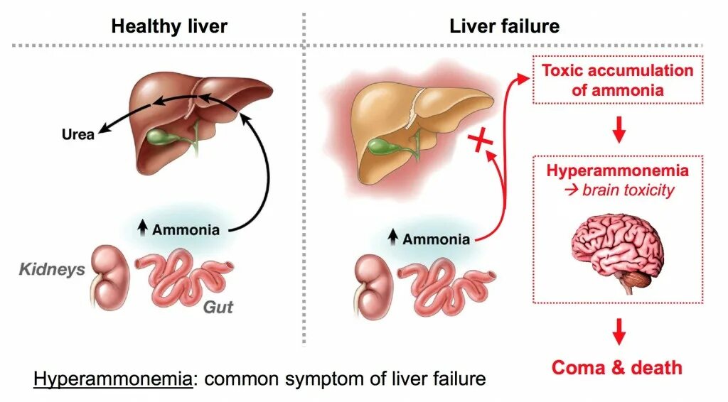 Синдромы недостаточности печени. Острая печеночная недостаточность печеночная энцефалопатия. Синдром печеночной энцефалопатии клиника. Острая печеночная недостаточность клиника по стадиям. Печень при печеночной недостаточности.