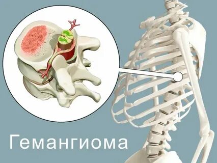 Гемангиома позвонка как лечить