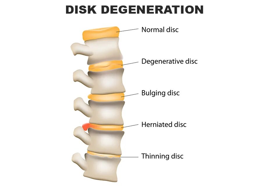 Боли в спине протрузии. Протрузия межпозвонковых дисков. Грыжи и протрузии позвоночника. Протрузия и грыжа. Протрузия дисков позвоночника что это такое.