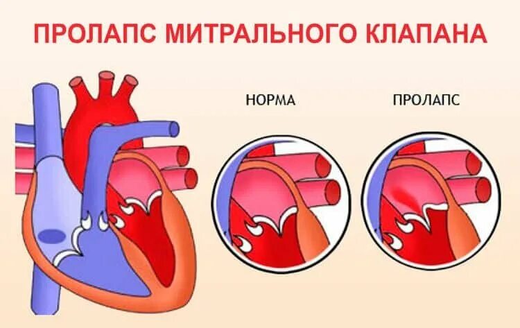 Что такое пролапс митрального клапана. Пролапс нейтрального клапана сердца 1 степени. Пролабирование створок митрального клапана. Пролабирование передней створки митрального клапана норма. Пролапс створок митрального клапана.