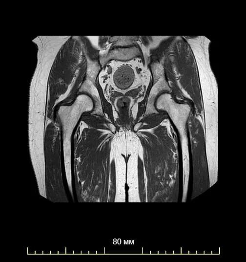 Что лучше кт или мрт тазобедренного сустава