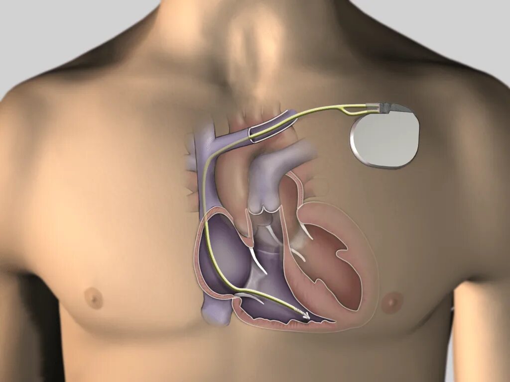 Performing CPR and Using an AED Safely