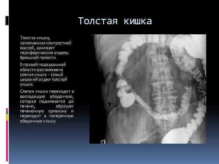 Расположение подвздошной кишки в брюшной полости Двенадцатиперстной кишки и толстого: найдено 90 изображений