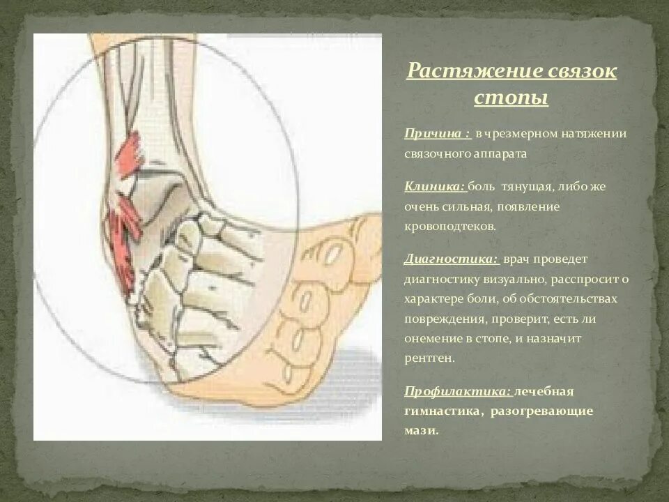 Сколько проходит растяжение стопы. Повреждение связочного аппарата стопы. растяжение сухожилия стопы. растяжение медиальной связки стопы.