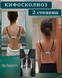 Кифосколиоз
