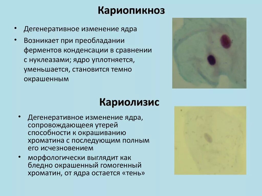 Кариорексис кариолизис. Кариопикноз кариорексис кариолизис апоптоз. Изменения ядра клетки. Патология клеточного ядра.