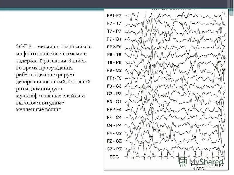Ээг отзывы детям. ЭЭГ интерпретация результатов. Нормы ритмов при ЭЭГ. Вертексные потенциалы на ЭЭГ. Альфа ритм на ЭЭГ норма.