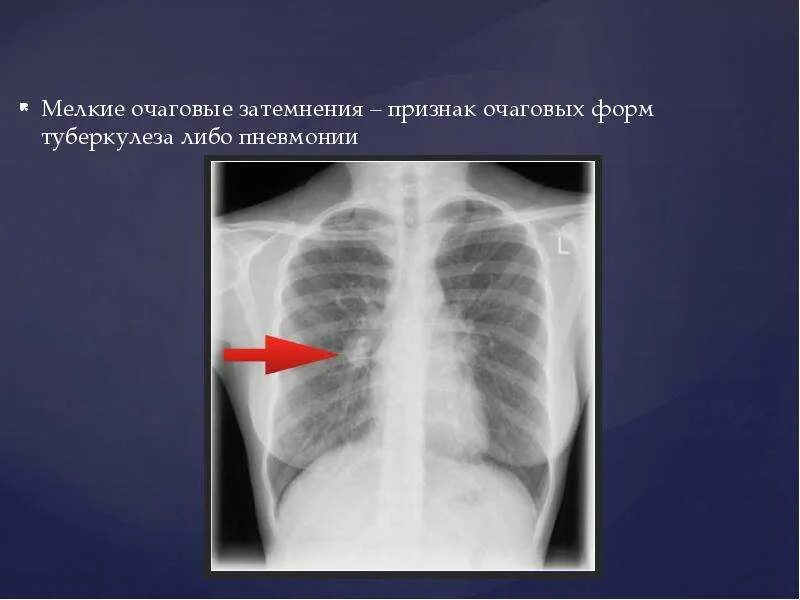 Ограниченное затемнение легочного поля. Инфильтрат ассмана рентген. Очаговое затемнение в легких. Инфильтративный туберкулез рентгенограмма. Очаговый туберкулез рентген признаки.