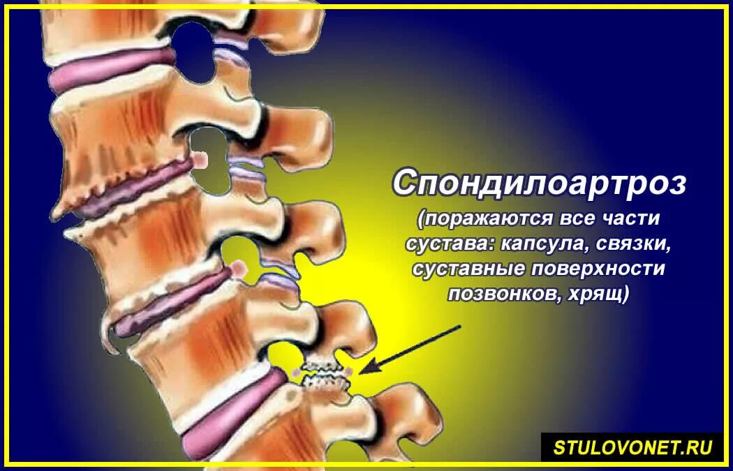 Спондилоартроз с6-th1. Спондилез позвоночника. Спондилоартроз c3/c4. Спондилоартроз th5 - th12.. Начальный спондилез