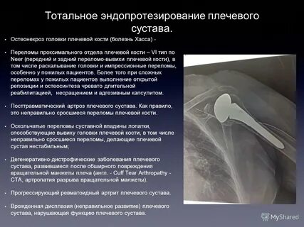 Проксимальный перелом плечевой кости