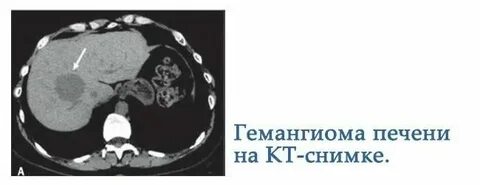 Болит печень гемангиома