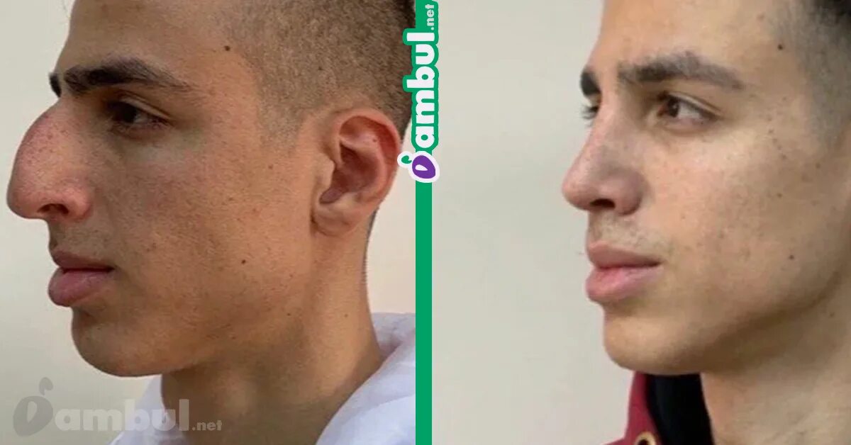 Бабич после операции на нос. Щербаков Леха ринопластика. Ахмед Рахматуллаевич ринопластика. Ринопластика носа мужчины до и после.