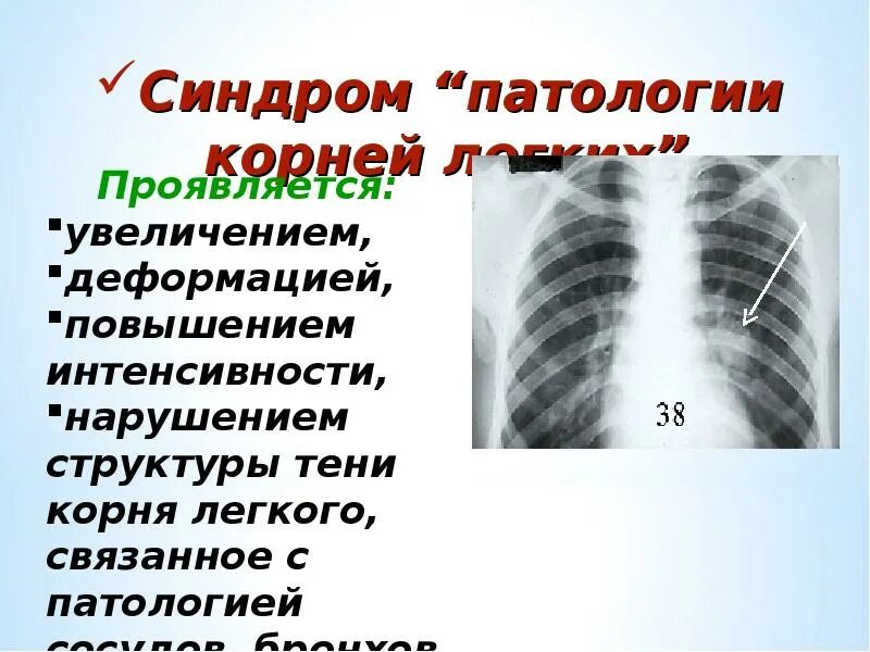 Прикорневой легочный рисунок. Синдром патологии корня легкого. Корни легких на флюорографии. Деформация корня легкого.
