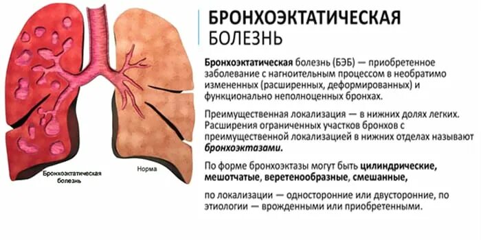 Бронхит бронхоэктатическая болезнь. Бронхоэктатическая болезнь (Бэб). Бронхоэктатическая болезнь и эмфизема. Хронический бронхит и бронхоэктатическая болезнь. Возможная причина кашля при бронхоэктатической болезни.