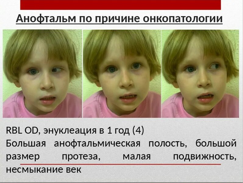 Анофтальм