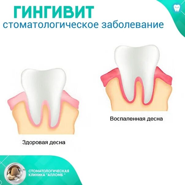 Острый генерализованный гингивит. Десквамативный гингивит. Фиброзный гипертрофический гингивит.