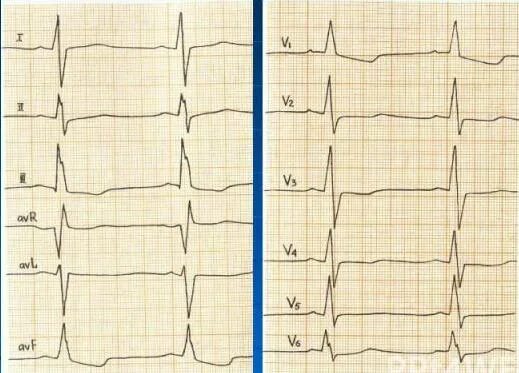 Неспецифические нарушения реполяризации на ЭКГ. Фаза реполяризации на ЭКГ. Нарушение процесса реполяризации желудочков. Гипертрофия левого желудочка с нарушением реполяризации на ЭКГ.