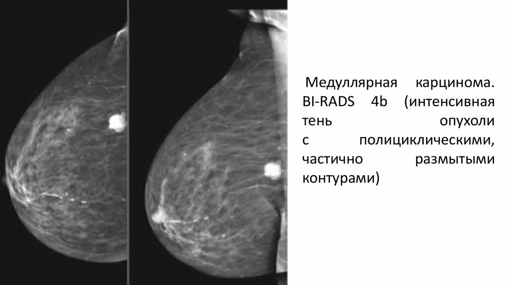 Маммография молочных bi-rads 2. Фиброзно кистозная мастопатия молочной железы bi-rads-4a. Маммография шкала bi-rads. Категория bi rads маммография. Левая железа bi rads 2