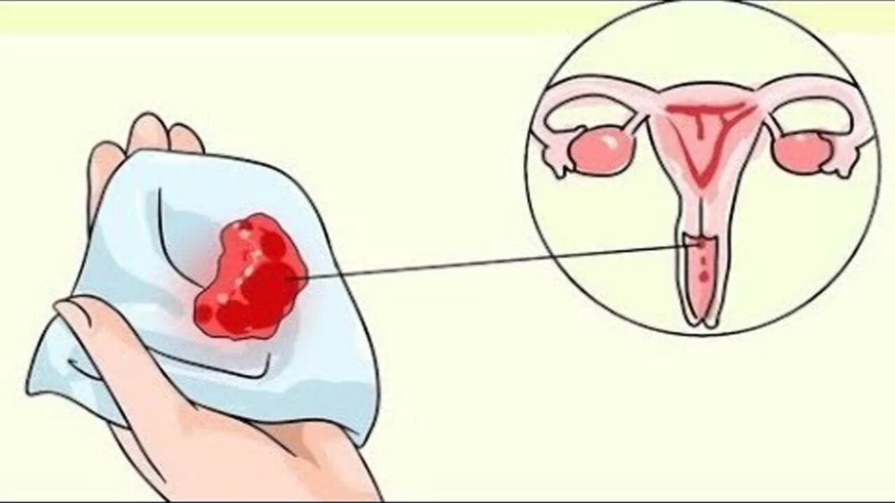 Кровотечение при раке матки. Вагинальное кровотечение. Кровотечение из половых органов. Менструальное кровотечение. Влагалищное кровотечение.