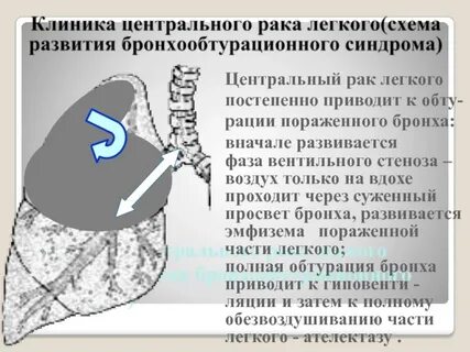 Рак легких прогноз