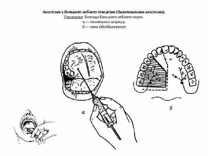 Блокада носа. Небная анестезия зона обезболивания. Палатинальная анестезия методика. Палатинальная анестезия схема. Палатинальная анестезия верхней челюсти.