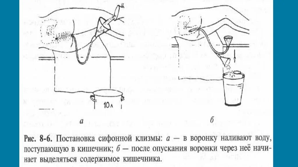 Температура воды для постановки очистительной. Постановка сифонной клизмы алгоритм. Постановка сифонной клизмы детям алгоритм. Постановка очистительной и сифонной клизмы алгоритм. Сифонная клизма алгоритм выполнения.