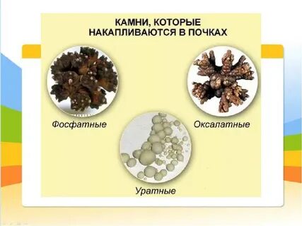 Почечный песок