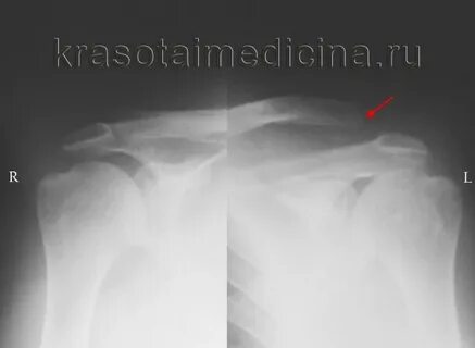 Вывих акромиального конца ключицы