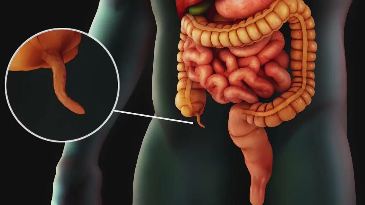 Что делает аппендикс. Флегмонозный аппендикс. Флегмонозный аппендицит отросток. Строение кишечника аппендикс.