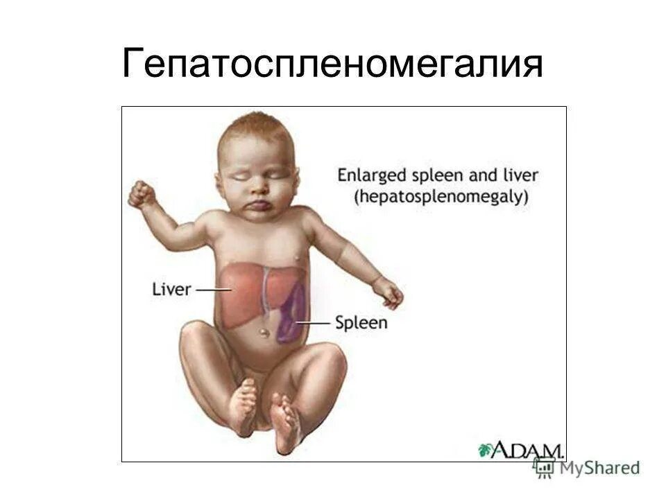 Симптомы печени у ребенка. Синдром гепатоспленомегалии. Гепатоспленомегалии что такое у детей. Синдром гепатомегалии и гепатоспленомегалии.