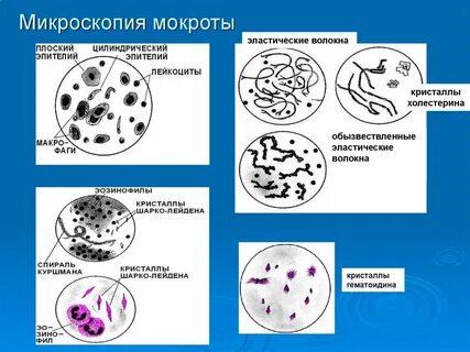 Анализ мокроты лейкоцитов