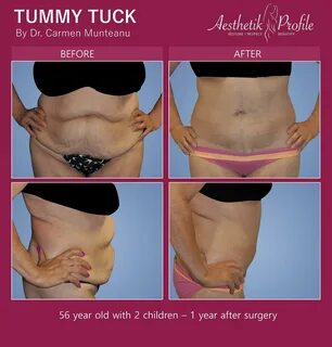 Slideshow sex after tummy tuck with muscle repair.