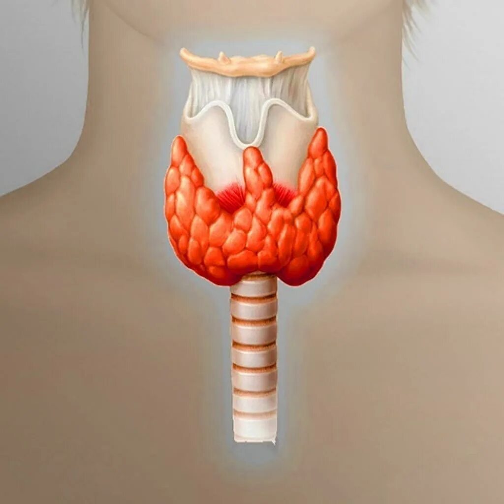 Зобом является. Диффузный токсический зоб щитовидной железы. Токсический зоб щитовидка. Диффузный токсический зоб (ДТЗ).