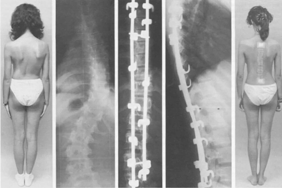 Сколиоз позвоночника 4 степени. Операция Харрингтона сколиоз. Метод Харрингтона сколиоз рентген. Дистрактор Харрингтона. Сколиоз 4 степени рентген.