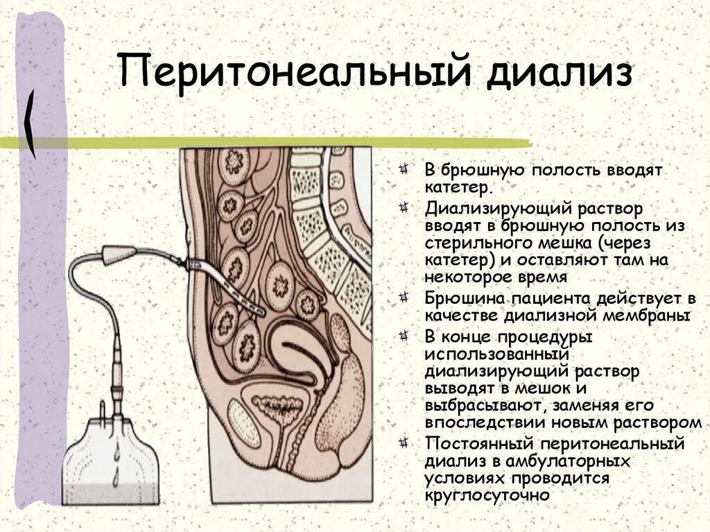Пункция брюшной полости, лапароцентез, лапароскопия. Катетер в брюшной полости. Перитонеальный диализ фото. Перитонеальный дренаж. Перитониальный диализ катетер.