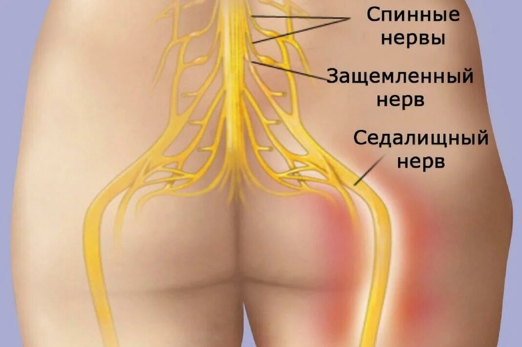 Боли в пояснице нервы. Седалищный нерв анатомия схема. Защемление седалищного нерва. Седалищный нерв ягодичный нерв. Анатомия. Седалищный нерв в ягодице.