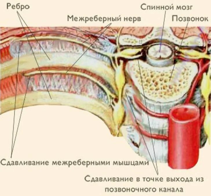 Невралгия при вдохе. Межреберная невралгия между ребрами. межреберная невралгия, торакалгия.. межреберный нерв симптомы. межребепная неврология.