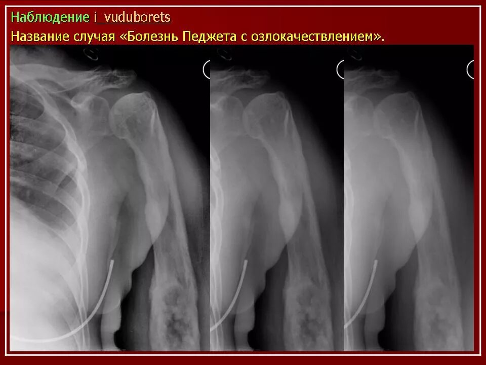 Уплотнена деформирована