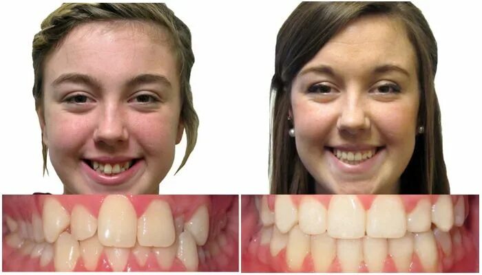 Ношение брекетов до и после. Исправление прикуса брекетами до и после. Исправление кривых зубов. Изменения после брекетов