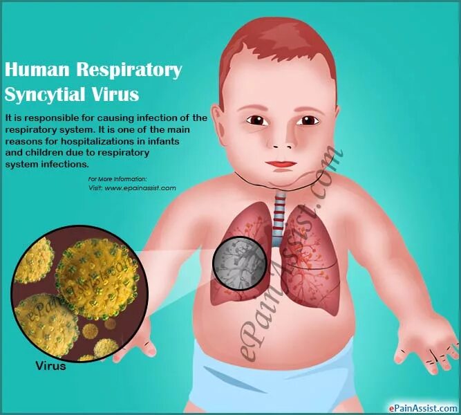 Respiratory virus. Респираторно-синцитиальный вирус человека. РС вирусная инфекция у детей. Респираторно синтициальная инфекция у детей.