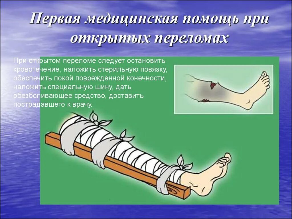 Если при открытом переломе имеется повреждение артерии. При переломах костей конечностей накладывается шина:. При переломе костей голени Шира накл. Накладывание шины при переломе костей конечностей. Наложение шины при открытом переломе.