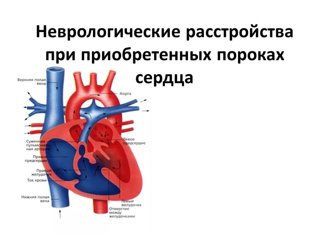 Приобретенные пороки сердца. Приобретённыей порок сердца. Комбинированный порок сердца.