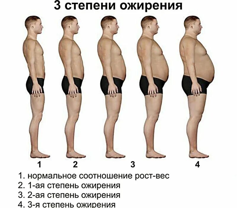 Твердый живот у мужчин причины. Ожирение 3 степени у мужчин. Ожирение 1 степени у мужчин. 1 Стадия ожирения у мужчин. Ожирение 1 2 3 степени у женщин.