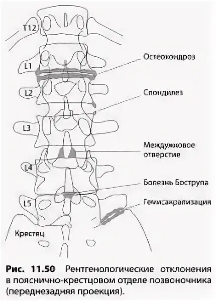 Синдром бааструпа. Синдром baastrup позвонков. синдром бострупа рентген. переднезадняя проекция.