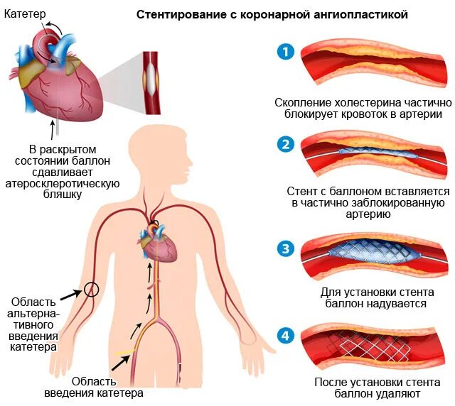 Сколько длится стентирование сосудов сердца