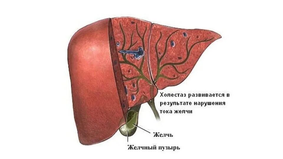 Холестаза желчного пузыря. Внутрипеченочный холестаз беременных. Холестаз печени симптомы