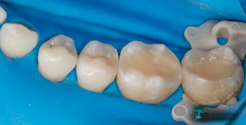 Приемы восстановления больших дефектов жевательных зубов. Метод окклюзионной мод