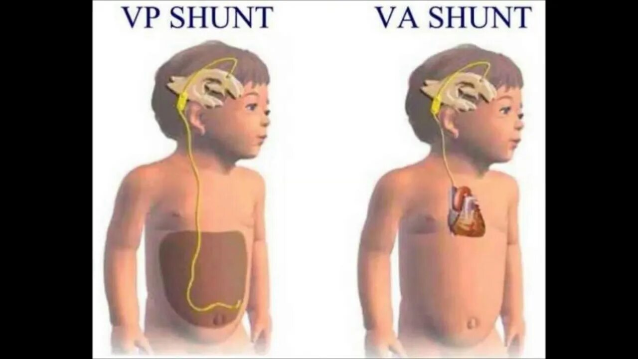 Вентрикулоперитонеального шунтирования. Шунт при гидроцефалии схема.