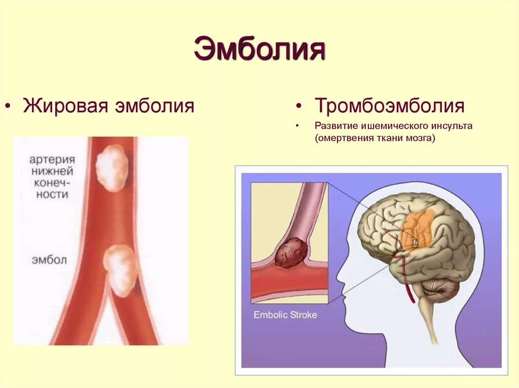 Закупорка головных сосудов. Жировая тромбоэмболия.